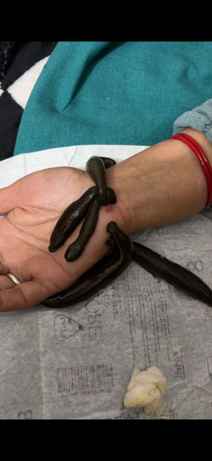 Leech_therapy