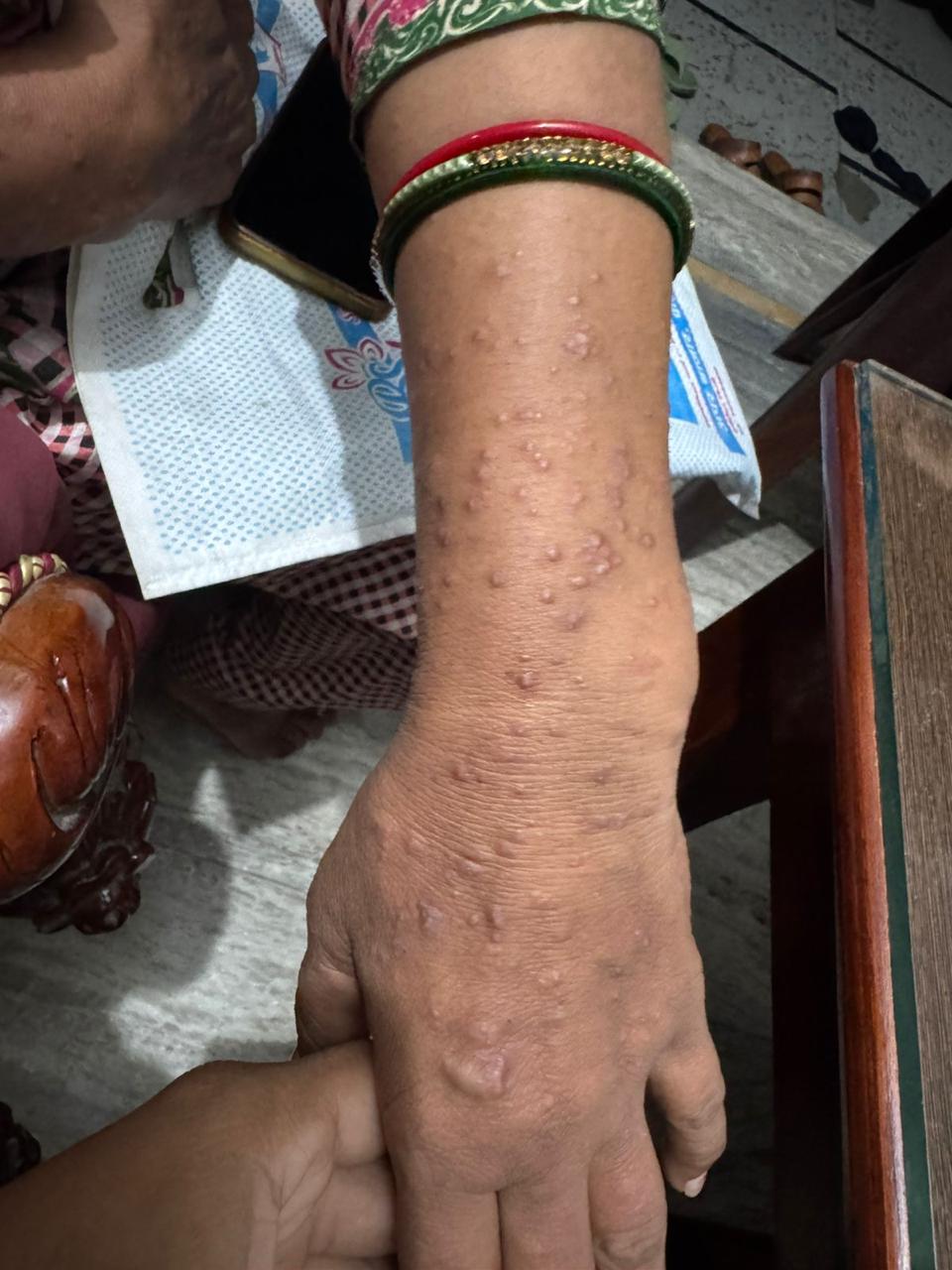 Skin_disorder