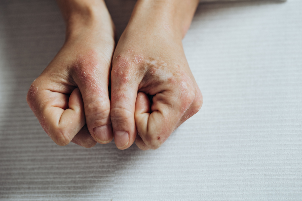 Psoriasis-Treatment
