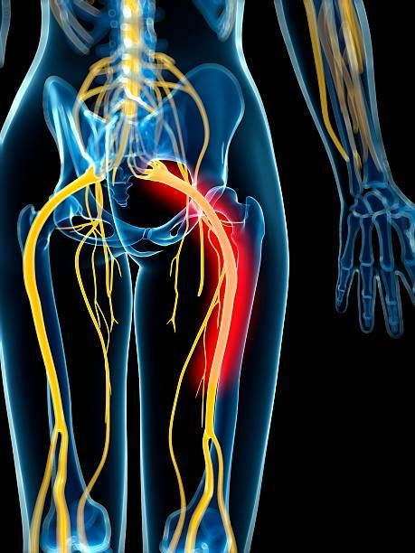 sciatic-treatment-in-ayurveda