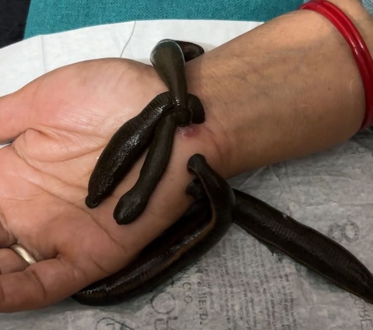 Leech_therapy